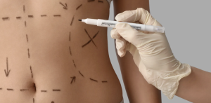 360 Liposuction Near Arlington VA